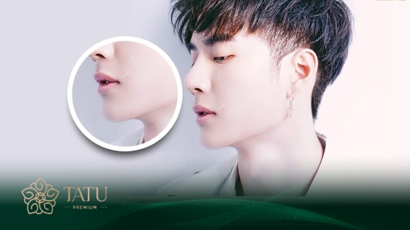 Chỉnh hình cằm giúp các anh nam sở hữu dáng cằm chữ V đẹp chuẩn idol Hàn