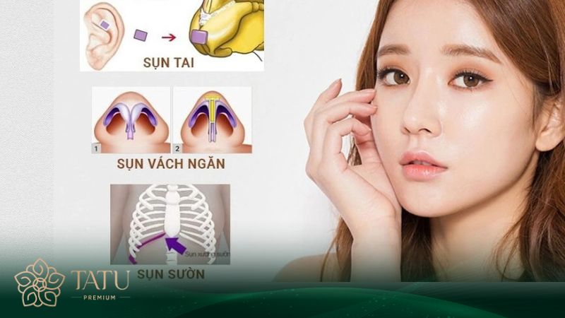 Có 3 dịch vụ sửa mũi sụn tự thân phổ biến