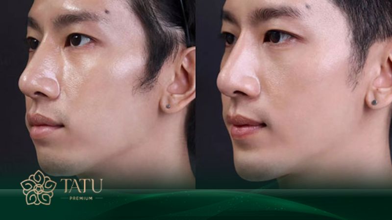 Phẫu thuật tạo hình dáng cằm vline