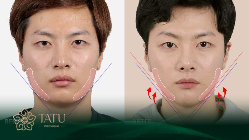 Viện thẩm mỹ Tatu Premium tạo hình cằm vline đẹp, tăng vượng khí