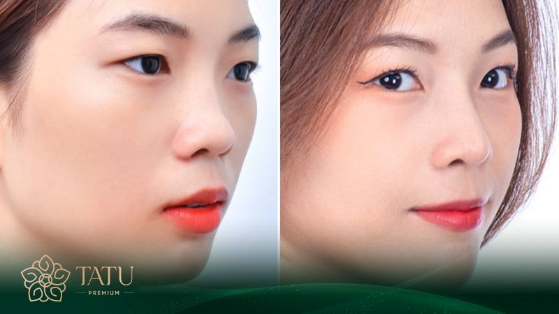 Giá phẫu thuật nâng mũi S line tại Việt Nam khá hợp lý