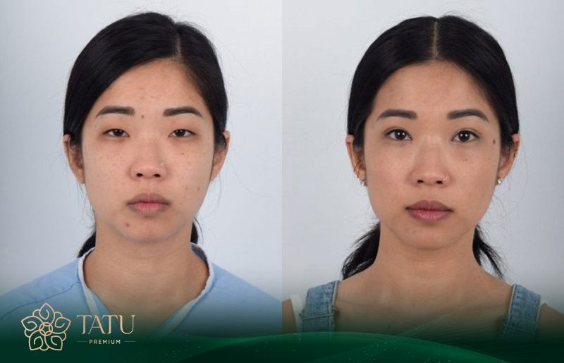 Để mí mắt vào form đẹp và ổn định hoàn toàn thường cần khoảng 3 tháng