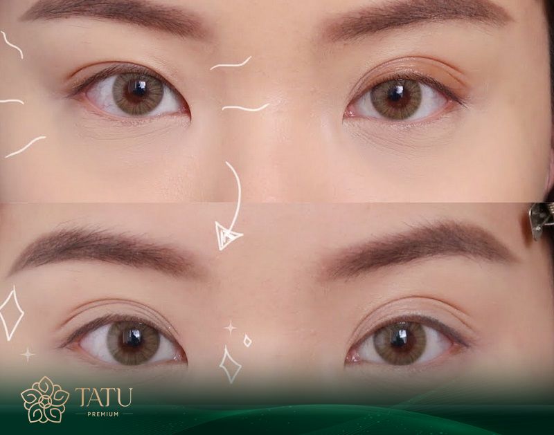Phẫu thuật mí mắt tại TATU Premium giúp bạn loại bỏ toàn bộ rủi ro cắt mí không đều.