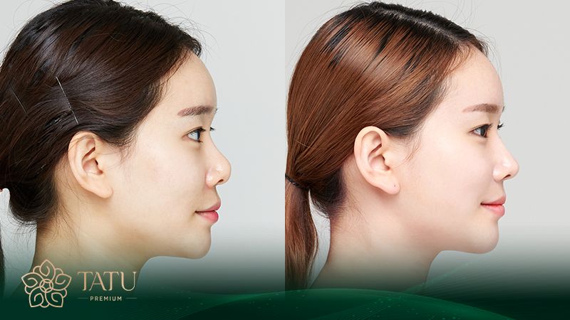 Nâng mũi S line hết bao nhiêu tiền là câu hỏi được nhiều người quan tâm
