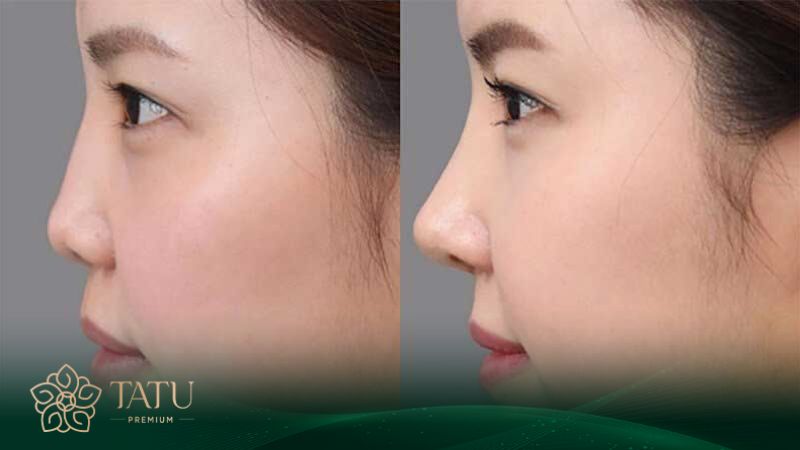 Thay đổi trước và sau khi nâng mũi bằng sụn tai