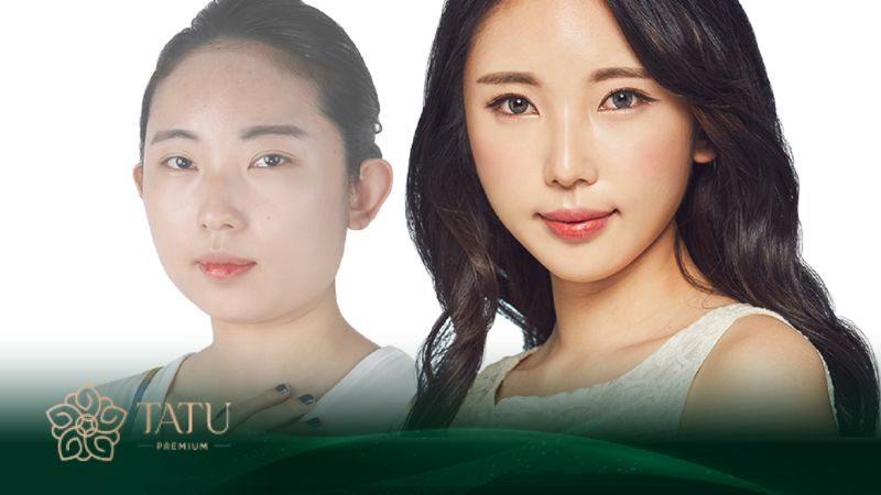 Mỗi ca khách hàng chỉnh cằm thành công là niềm vui của Tatu Premium