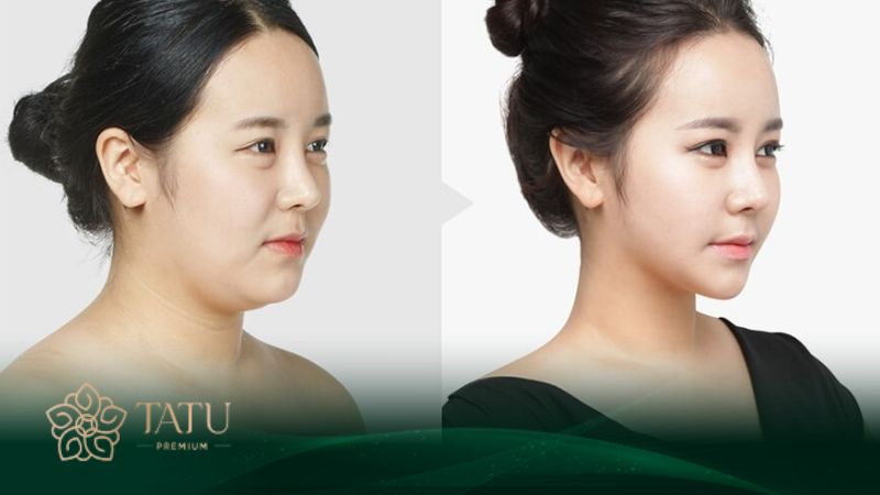 Quy trình tạo dáng cằm trái xoan thon gọn chữ V an toàn, đáp ứng tiêu chuẩn khắt khe của Bộ y tế