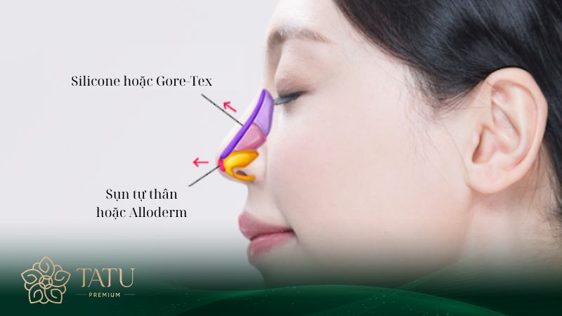 Chọn 1 trong 2 kỹ thuật nâng Sline giúp cải thiện vận mệnh