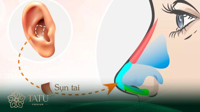 Giải đáp thắc mắc nâng mũi bằng sụn tai có tốt không?