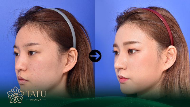 Nâng mũi sụn tự thân có thể kéo dài vĩnh viễn