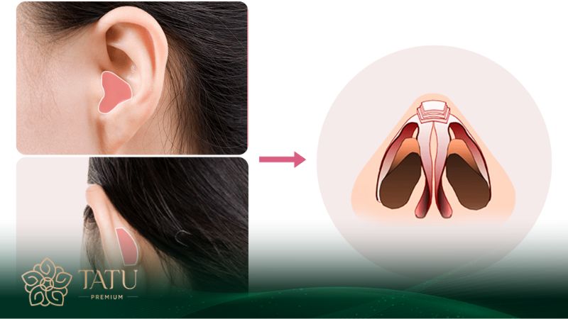 Nâng mũi bằng sụn tự thân khá phổ biến