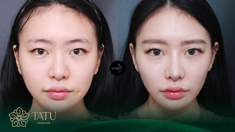 Nâng mũi phong thủy theo dáng S line khá thịnh hành