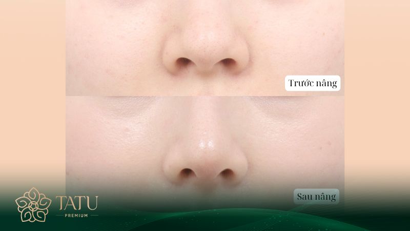 Căn chỉnh lại khuyết điểm mũi chưa đẹp
