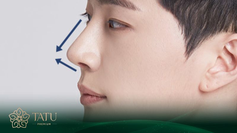 Nâng mũi S line tự nhiên phù hợp cho cả nam và nữ