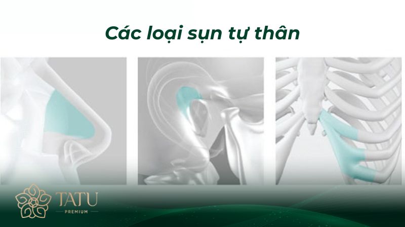 Các loại sụn tự thân được dùng phổ biến