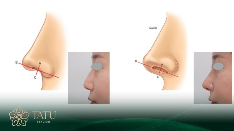 Phẫu thuật mũi S line giúp chỉnh sửa khuyết điểm cũ đầy hiệu quả