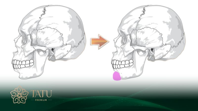 Bác sĩ tại Tatu Premium sẽ mô phỏng trước dáng cằm cho khách hàng