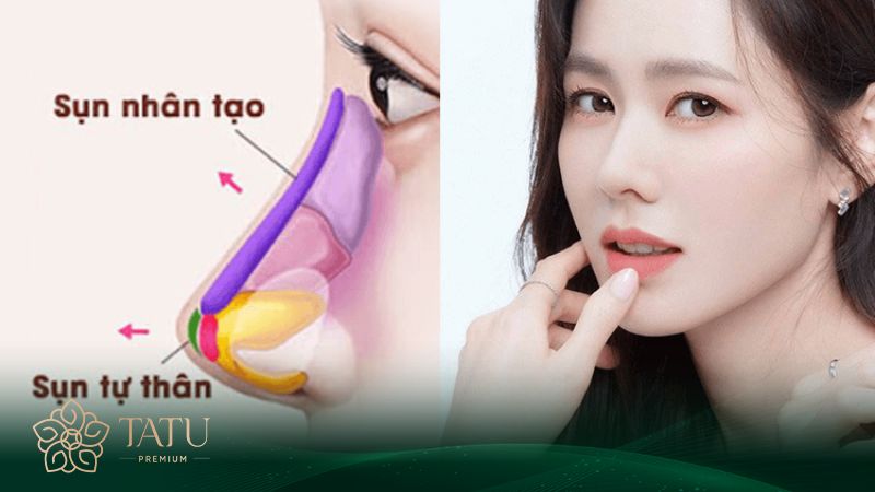 Bọc sụn đầu mũi là phương pháp nâng S line được áp dụng phổ biến