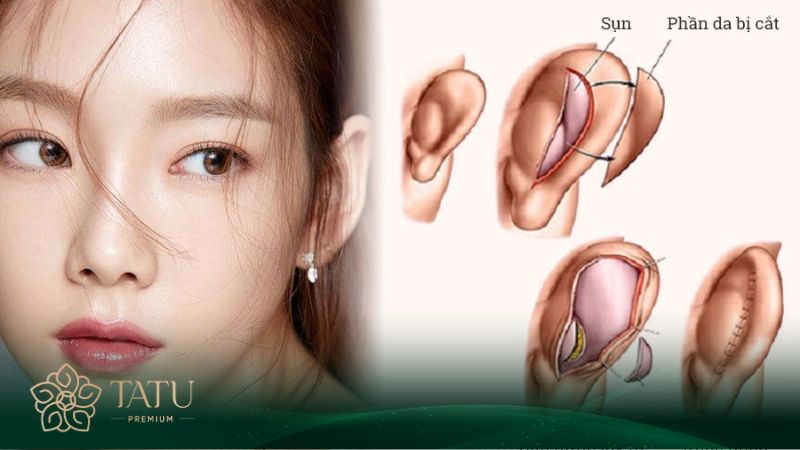 Nâng mũi bằng chất liệu sụn tai tự thân