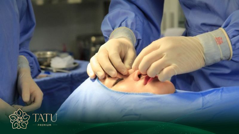 Quy trình nâng mũi Sline tổng có 4 bước