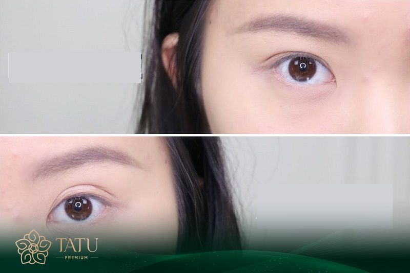 Độ sâu của nếp mí không chỉ ảnh hưởng đến tính thẩm mỹ mà còn tác động đến cảm nhận của người đối diện khi giao tiếp.