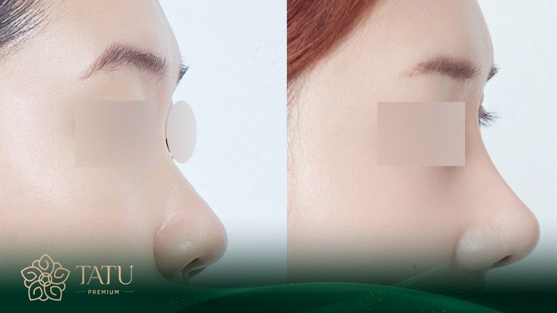 Thẩm mỹ nâng mũi S-line ngày một thịnh hành