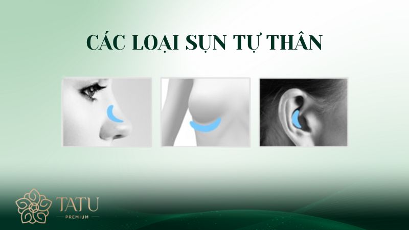Những vị trí được tiến hành lấy sụn tự thân
