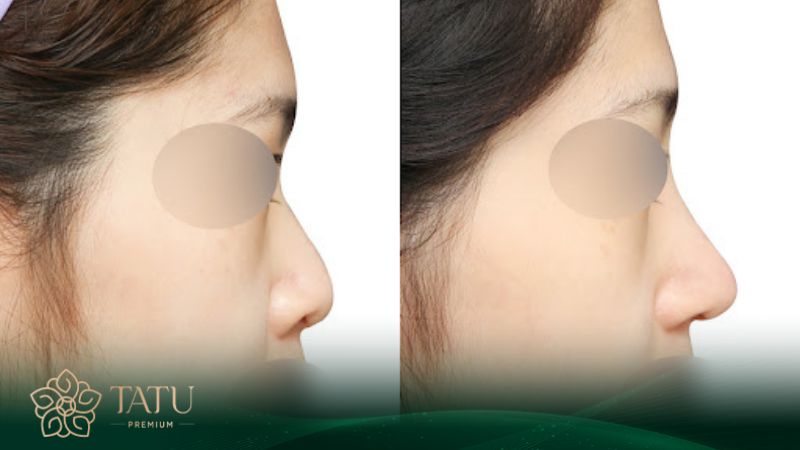 Nâng mũi bằng sụn tai bao nhiêu phụ thuộc vào nhiều yếu tố