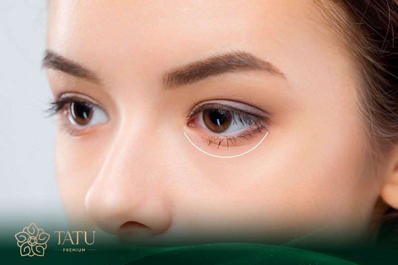 Bác sĩ sẽ dùng dụng cụ vô khuẩn để rạch một đường nhỏ sát viền mi dưới