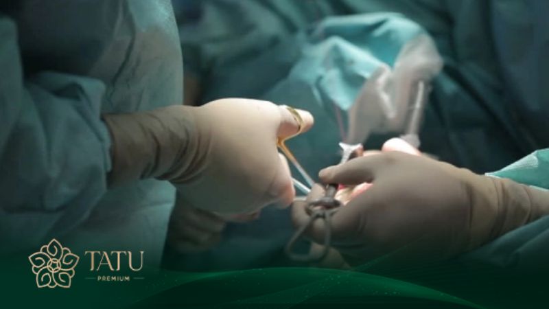 Phẫu thuật cắt xương hàm cải thiện dáng cằm thon gọn