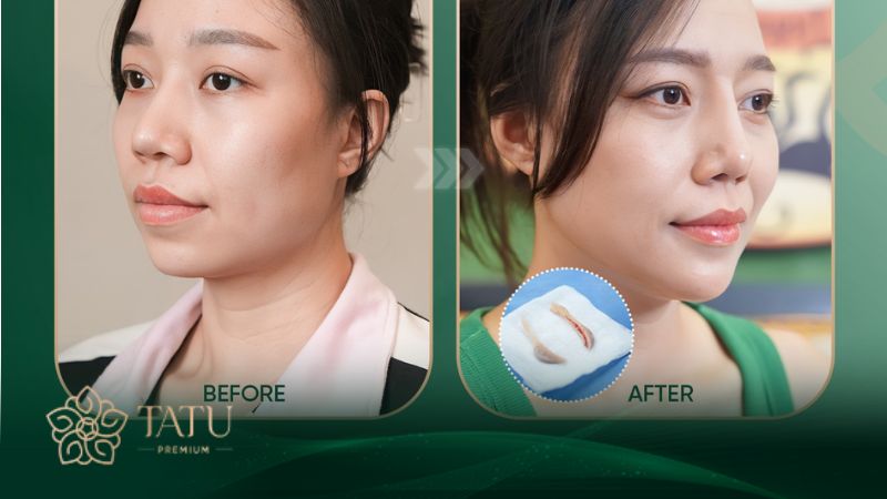 Hình ảnh khách hàm sau khi chỉnh cằm tại Viện thẩm mỹ Tatu Premium