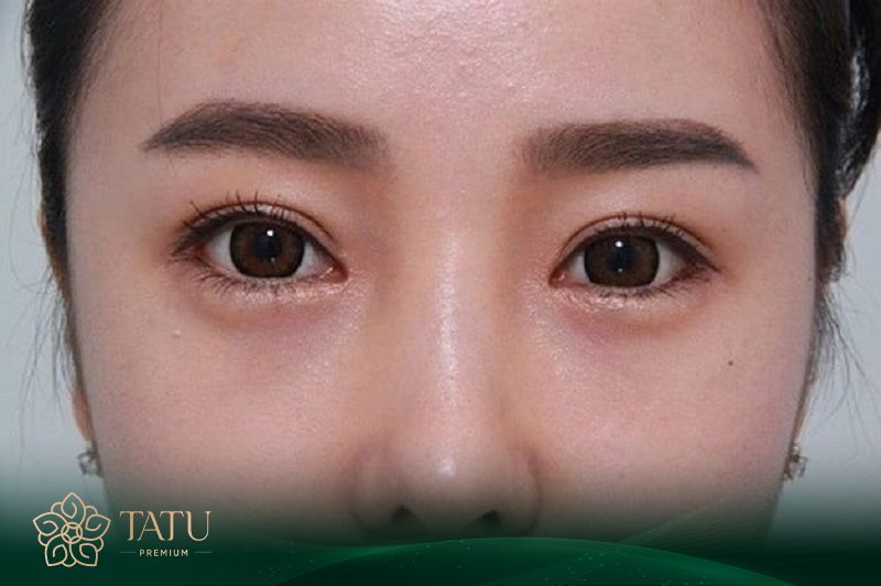 Nếu thấy hai mắt lệch nhau, mí không rõ nét, nhiều khả năng quá trình chăm sóc trước đó đã xảy ra sai sót.