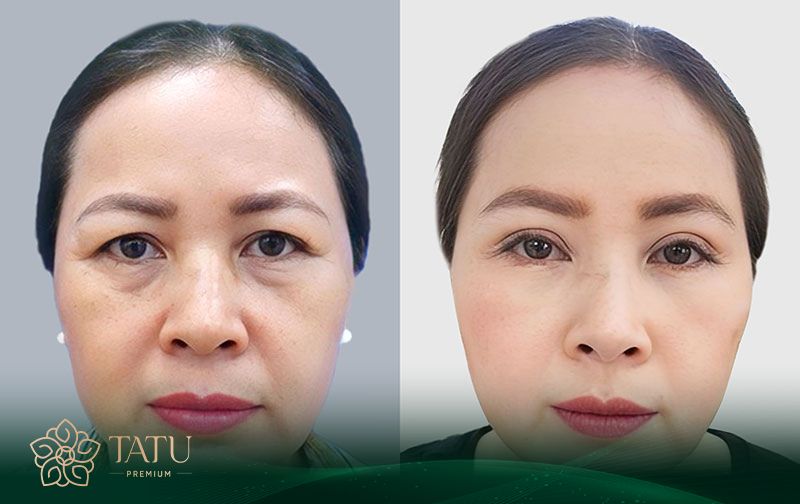 Cắt mí dưới có để lại sẹo hay không phụ thuộc 95% vào khả năng chuyên môn của đơn vị thực hiện phẫu thuật