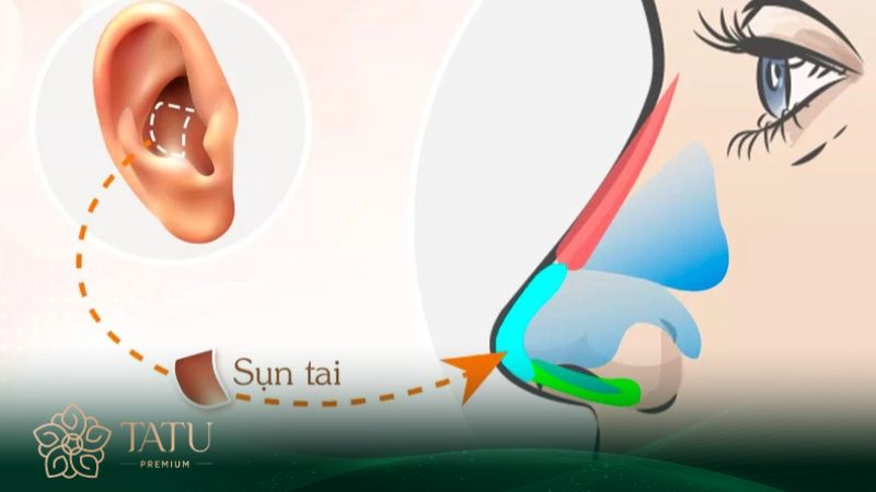 Giải đáp thắc mắc nâng mũi bọc sụn bao nhiêu tiền
