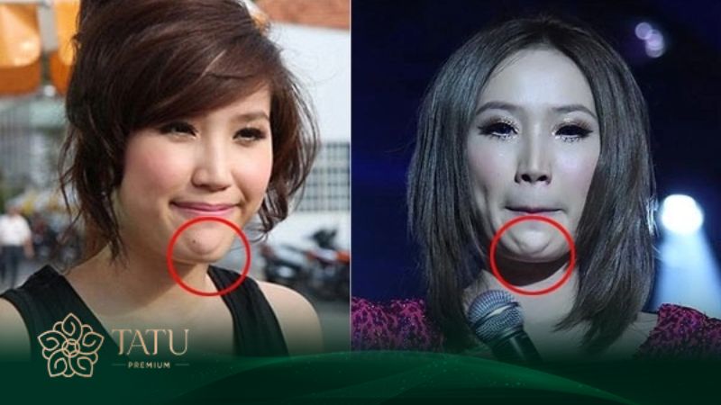Lo sợ độn cằm nhìn giả, không tự nhiên