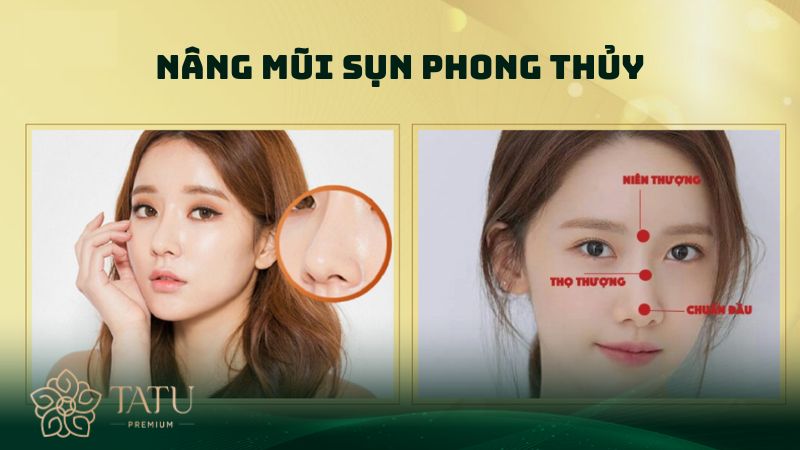 Nâng mũi sụn phong thủy ngày càng được nhiều người biết tới