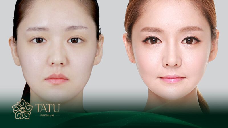 Tạo hình dáng cằm dài giúp khuôn mặt đẹp, tự nhiên