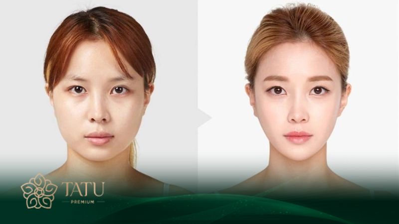Gọt cằm là phương pháp chỉnh sửa cấu trúc xương cằm
