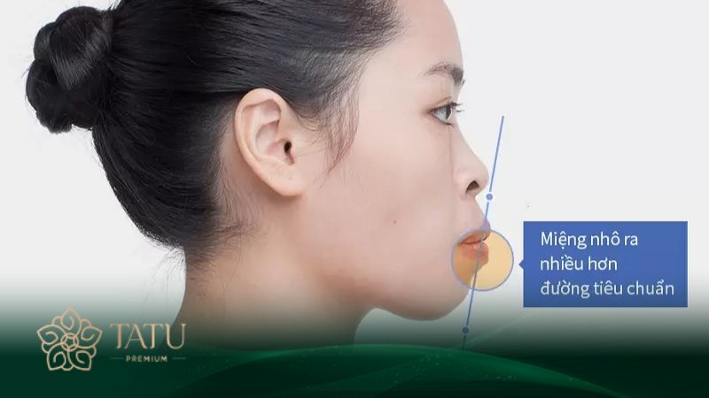 Gọt xương hàm tạo dáng mặt V line thon gọn