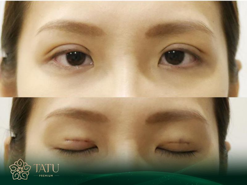 Chỉ sau 1 tiếng, khách hàng sẽ sở hữu đôi mắt to tròn với hai mí rõ nét, chuẩn phong thủy giúp cải thiện tướng số.
