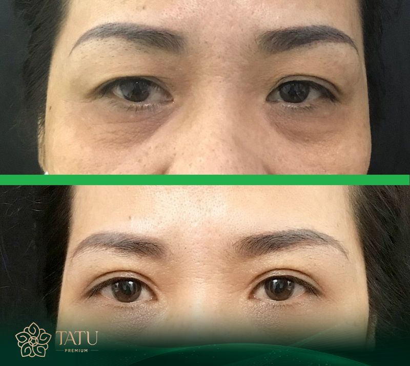 Cắt mí tại TATU Premium nhanh lành, sớm vào nếp.