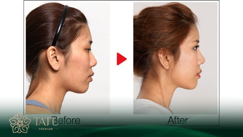 Nâng mũi bằng sụn tự thân hoàn toàn có thể khắc phục được nhiều khuyết điểm mũi