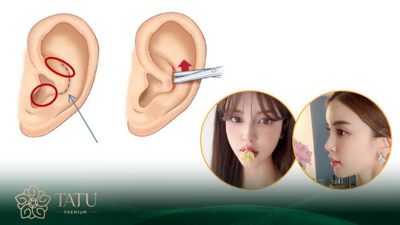 Sửa mũi bằng sụn tự thân có tính tương thích cao và an toàn
