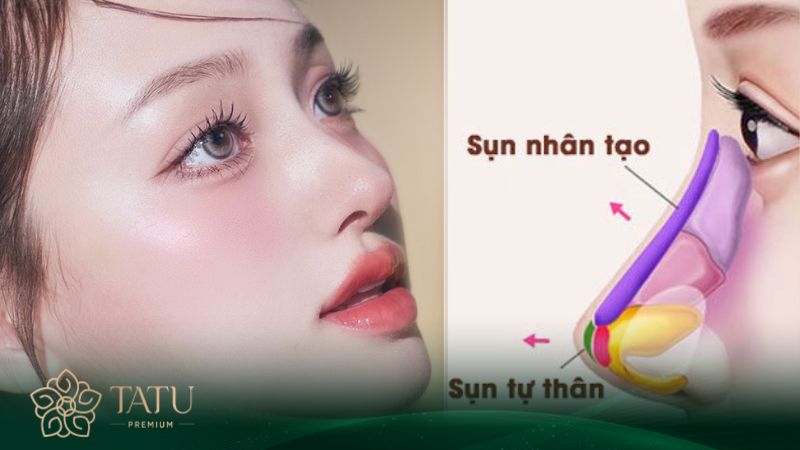 Dáng mũi bằng sụn tự thân L line