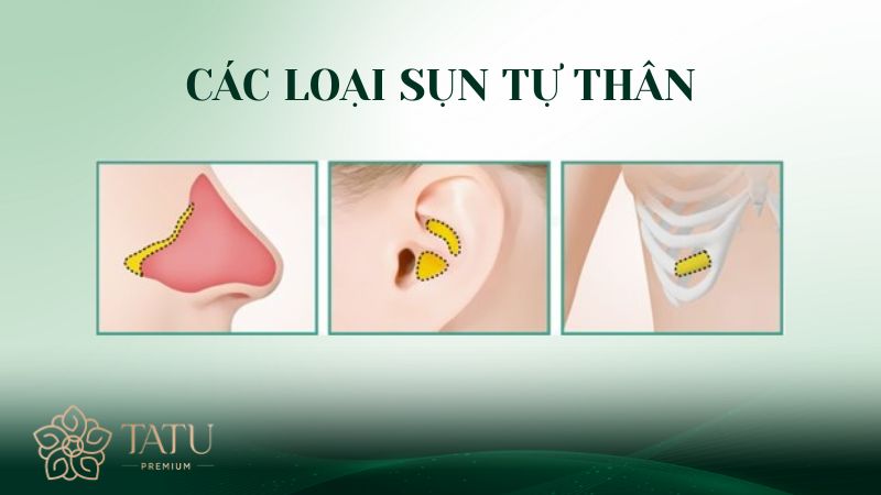 3 loại sụn tự thân thường xuất hiện trong nâng, chỉnh sửa mũi