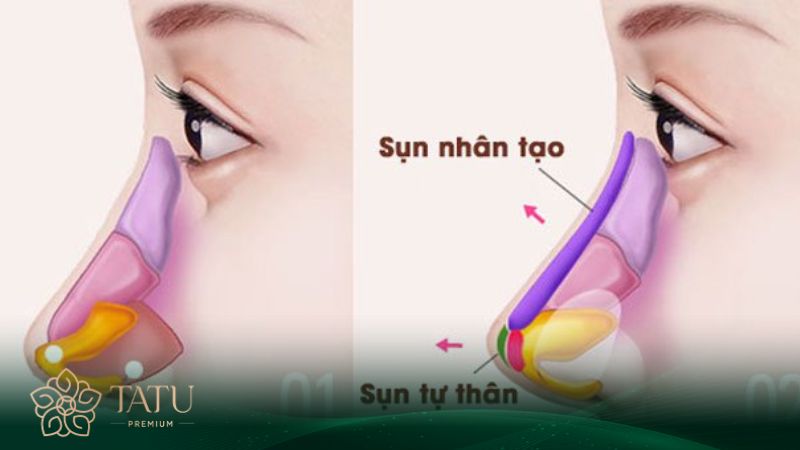 Sụn tự thân và sụn nhân tạo là 2 loại sụn được sử dụng nhiều nhất trong nâng mũi