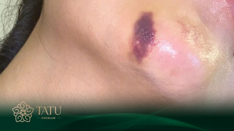 Cằm có thể bị bầm, sưng nhẹ
