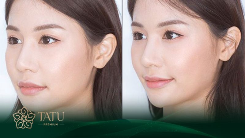 Tiêm filler cằm có thể duy trì 12 - 18 tháng