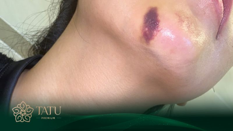 Sau tiêm filler cằm có thể bị bầm, tụ máu