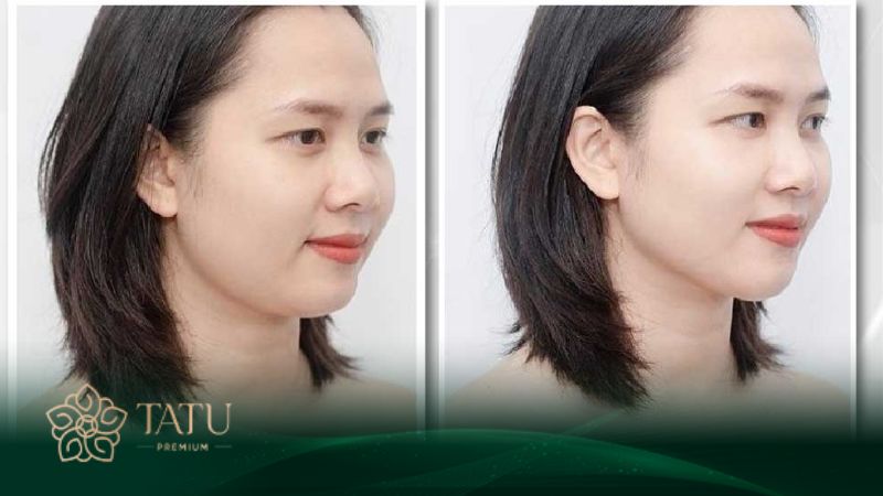 Tiêm tan mỡ nọng cằm tác động đến vùng mỡ dưới cằm